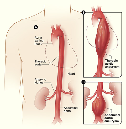 Diagram showing aneurysms