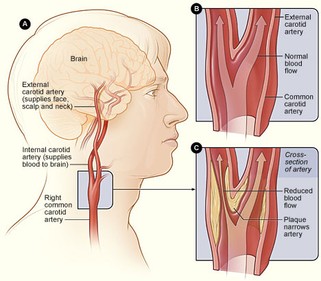 Diagram showing carotid artery anatomy and disease