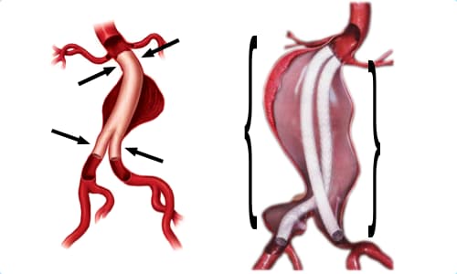 Nellix sealing vs fixation